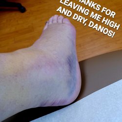 Dano's Clermont Cab - Broken leg, after having to drive on it. Thanks, Dano!