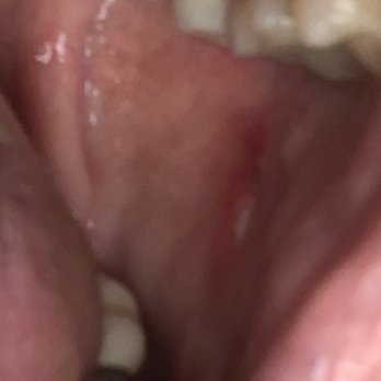 Aspen Dental - Hamden, CT - The hole in my cheek. - Oral Surgeons Near Me - Hamden, Connecticut Aspen Dental - Hamden, CT - The hole in my cheek. - Oral Surgeons Near Me - Hamden, Connecticut