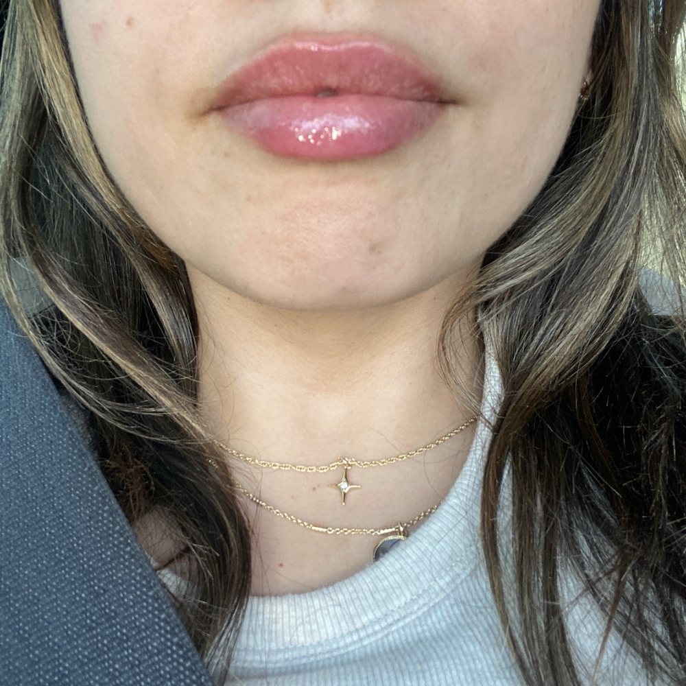 Heavenly Plastic Surgery - After with half syringe - Plastic Surgeons Near Me - Lake Forest, California Heavenly Plastic Surgery - After with half syringe - Plastic Surgeons Near Me - Lake Forest, California