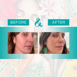 Natasha Bernard, DO - Alchemy Restorative Medicine - Rf microneedling before and after