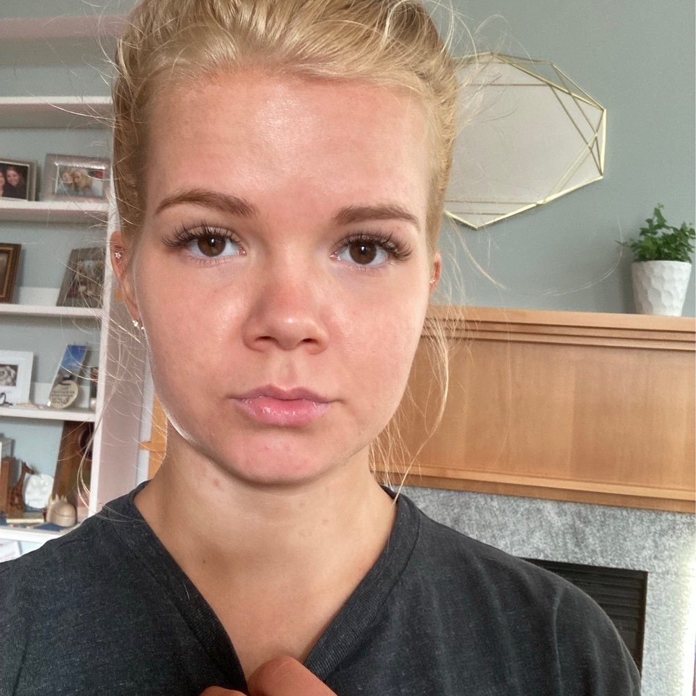 Splotches and weird rash contracted on neck after spray tan (I've had many over the years I'm not allergic ) Splotches and weird rash contracted on neck after spray tan (I've had many over the years I'm not allergic )