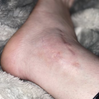 Select Foot and Ankle Specialists - 4 years post op!! - Podiatrists Near Me - Cypress, Texas Select Foot and Ankle Specialists - 4 years post op!! - Podiatrists Near Me - Cypress, Texas