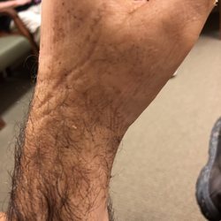 Lexington Orthopaedics West Columbia - Healing broken wrist