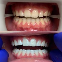 Vestavia Smiles - Zoom Whitening Treatment