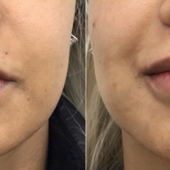 Dermacare Medical - Lip before and after juvederm augmentation - Skin Care Near Me - New York, New York Dermacare Medical - Lip before and after juvederm augmentation - Skin Care Near Me - New York, New York