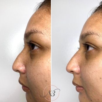 NuBella Med Spa - Liquid rhinoplasty by Nurse B to smooth the nasal bridge and mask a dorsal hump - Medical Spas Near Me - Irvine, California