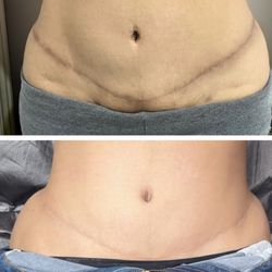 Parkway Esthetics - Tummy tuck scar before & after scar camo