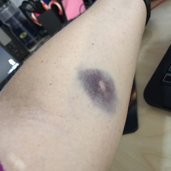 Quest Diagnostics - This was the bruise left from attempt #1, they finally got my blood by the third try. - Laboratory Testing Near Me - Anaheim, California