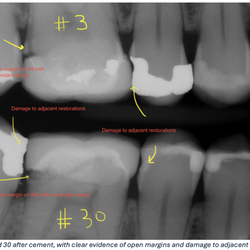 EZ Smile Family Dental Group - San Francisco - The margin (area where the crown contacts the natural tooth) is not sealed, allowing food and bacteria to enter the space between.