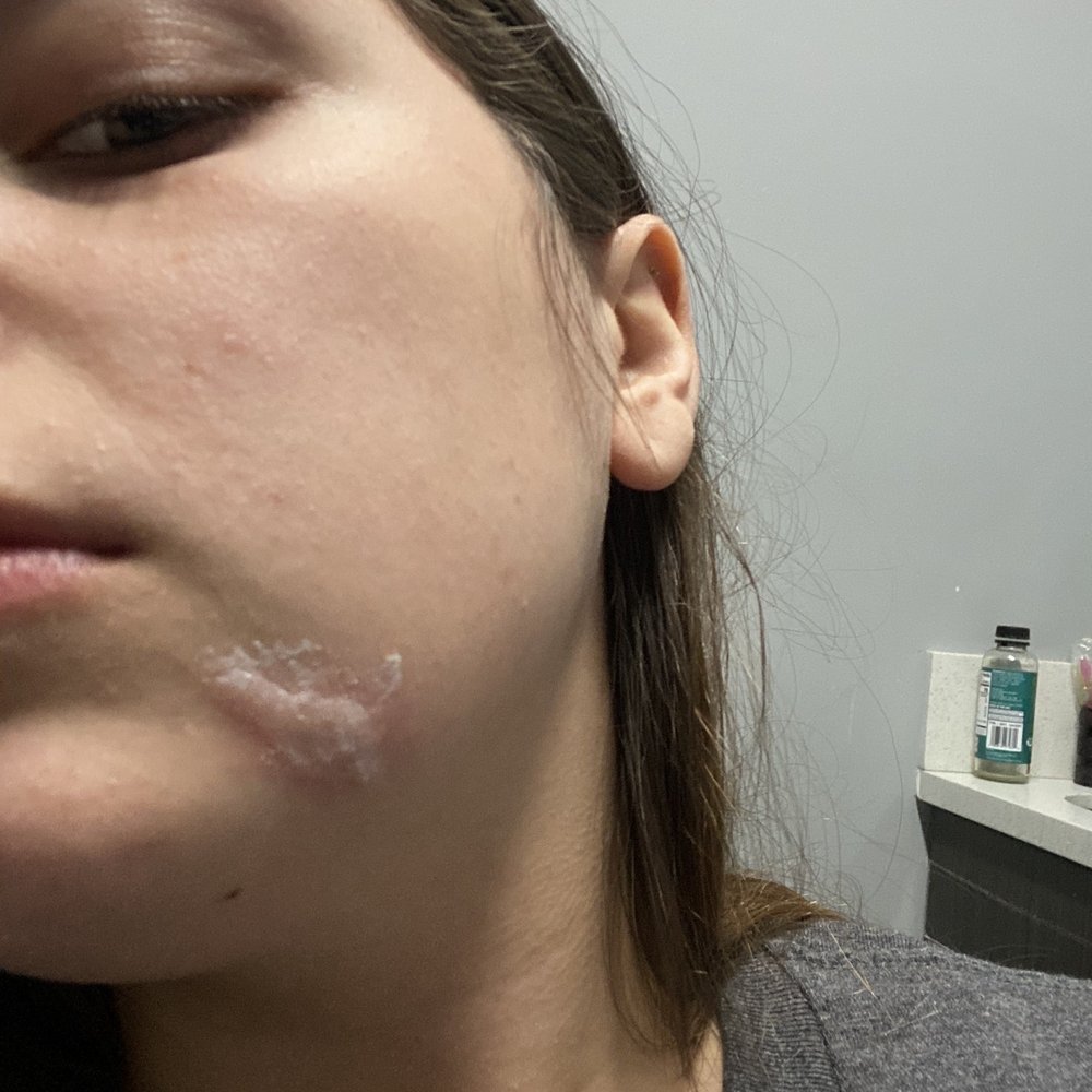 Chemical burn while getting fillings