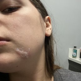 Chemical burn while getting fillings Chemical burn while getting fillings