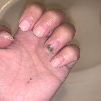 H2O Nails Spa - I cut off my acrylic, dipped them in acetone and removed them....Reveal infected nail! - Nail Salons Near Me - Monrovia, California