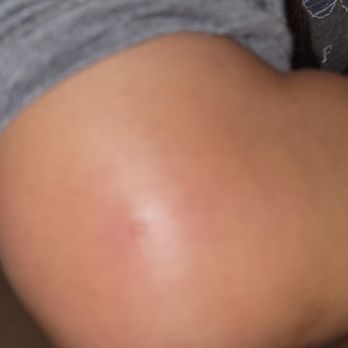 Hyatt Place Sumter / Downtown - Bed Bug bite on elbow - Hotels Near Me - Sumter, South Carolina Hyatt Place Sumter / Downtown - Bed Bug bite on elbow - Hotels Near Me - Sumter, South Carolina