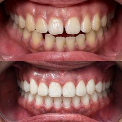 Crystal Dental - Invisalign transformed this smile by correcting an anterior open bite and closing upper and lower spacing.