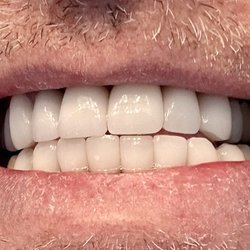Royal Dental Care - Full Veneer