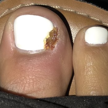 Teresa's Nails - Nasty infection from Teresa's Nails - Nail Salons Near Me - Carmichael, California Teresa's Nails - Nasty infection from Teresa's Nails - Nail Salons Near Me - Carmichael, California