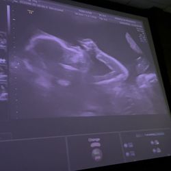 Miracle In Progress 3D4D Ultrasound Studio - LV - Another one! #babynumber9