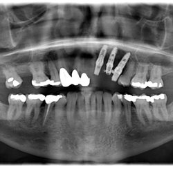 Daniel A Kaplan, DDS - Immediate dental implants replacement