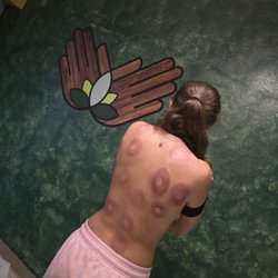 Heal'n Hand'z - Cupping sessions available!
