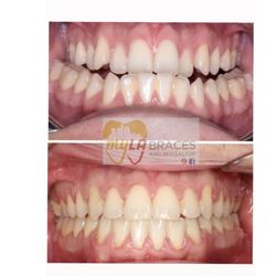 My LA Braces - Before & After