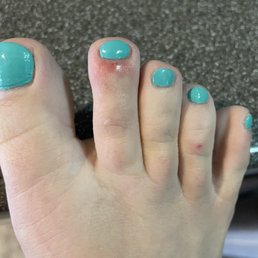 The red marks on my feet were from the nail tech. My second toe is swollen and irritated.