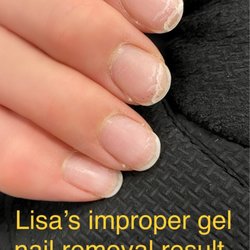 Bay Farm Nail Spa - Lisa's improper gel nail removal resulting in splinter hemorrhage, brittle, sides detached from violent pulling.