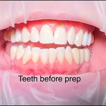 Pler Clinics - Teeth before prep - IV Hydration Near Me - North Miami Beach, Florida Pler Clinics - Teeth before prep - IV Hydration Near Me - North Miami Beach, Florida