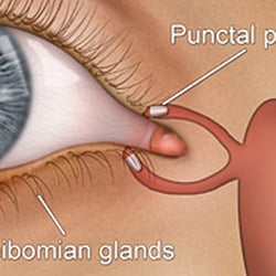 Larry D Sumner - Punctal plugs in drainage canals of the eyelid.