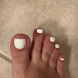 Bruised toe