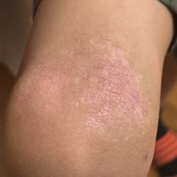 Stein Dermatology - After