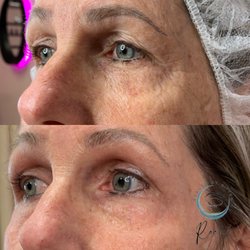Beauty By Kitten, Center For Advanced Aesthetics - Plasma Fibroblast healed 5 out of 12 weeks!