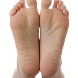 First Class Podiatry - Verruca treatments