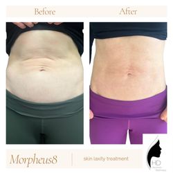 HD Aesthetic Wellness - Morpheus8 - Radiofrequency Microneedling