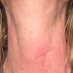 Crevello Albert J MD - 48hrs later taking two Benadryl's every four hours around-the-clock since It's swelled up