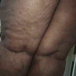 Buckner Vein and Aesthetics