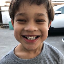 San Jose Dental Surgery Center - Can't even tell his 2 front teeth apart from the rest