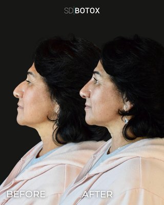 Non-Surgical Nose Job - Dr. Alex Roher has transformed hundreds of noses and profiles since he began his aesthetics career in 2011. Nose fillers, also known as a non-surgical nose job or liquid rhinoplasty, have become increasingly popular as a way to enhance the appearance of the nose without undergoing surgery. A non-surgical nose job provides instant gratification, and immediate results. The procedure is relatively quick and painless, with most patients experiencing minimal discomfort during the injection process. Non-Surgical Nose Job - Dr. Alex Roher has transformed hundreds of noses and profiles since he began his aesthetics career in 2011. Nose fillers, also known as a non-surgical nose job or liquid rhinoplasty, have become increasingly popular as a way to enhance the appearance of the nose without undergoing surgery. A non-surgical nose job provides instant gratification, and immediate results. The procedure is relatively quick and painless, with most patients experiencing minimal discomfort during the injection process.