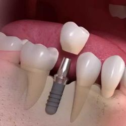 Napa Dental Implant Center