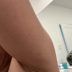 Houston Behavioral Healthcare Hospital - Proof of bruises