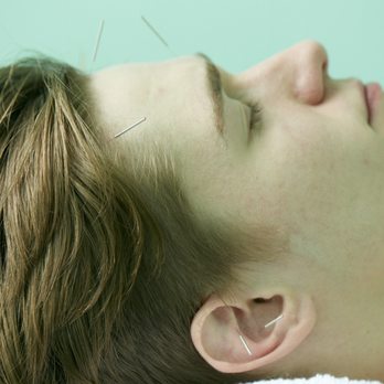 Acupuncture Williamsburg - Facial Rejuvenation Acupuncture - Acupuncture Near Me - Brooklyn, New York Acupuncture Williamsburg - Facial Rejuvenation Acupuncture - Acupuncture Near Me - Brooklyn, New York