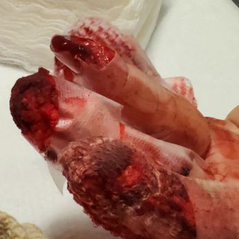 Guthrie Robert Packer Hospital - Broken fingers and mangled tips - Sports Medicine Near Me - Sayre, Pennsylvania