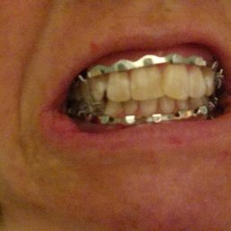 Fractured jaw, wired shut.