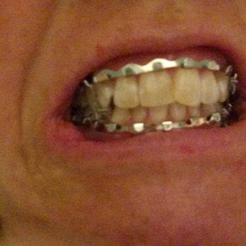Kanter Herbert M DDS - Fractured jaw, wired shut. - Oral Surgeons Near Me - Arlington Heights, Illinois