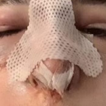 Kaveh Alizadeh, Cosmoplastic Surgery - How I was left after a 6 hour rhinoplasty procedure, as you can see from my before, not much was needed so I still don't know why it was 6H - Plastic Surgeons Near Me - New York, New York Kaveh Alizadeh, Cosmoplastic Surgery - How I was left after a 6 hour rhinoplasty procedure, as you can see from my before, not much was needed so I still don't know why it was 6H - Plastic Surgeons Near Me - New York, New York