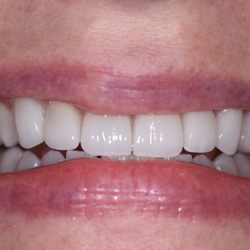Leatherwood Family and Cosmetic Dentistry - Failed tooth colored fillings replaced with porcelain veneers and crowns