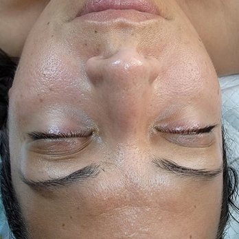 True Skin Aesthetics - These are before & after's. You can actually see my skin appears lighter in the after because she removed so much funk for my face. - Skin Care Near Me - Honolulu, Hawaii True Skin Aesthetics - These are before & after's. You can actually see my skin appears lighter in the after because she removed so much funk for my face. - Skin Care Near Me - Honolulu, Hawaii