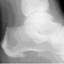 Min Wu - Suffering heel spur? I can help you back into yuor shoes.