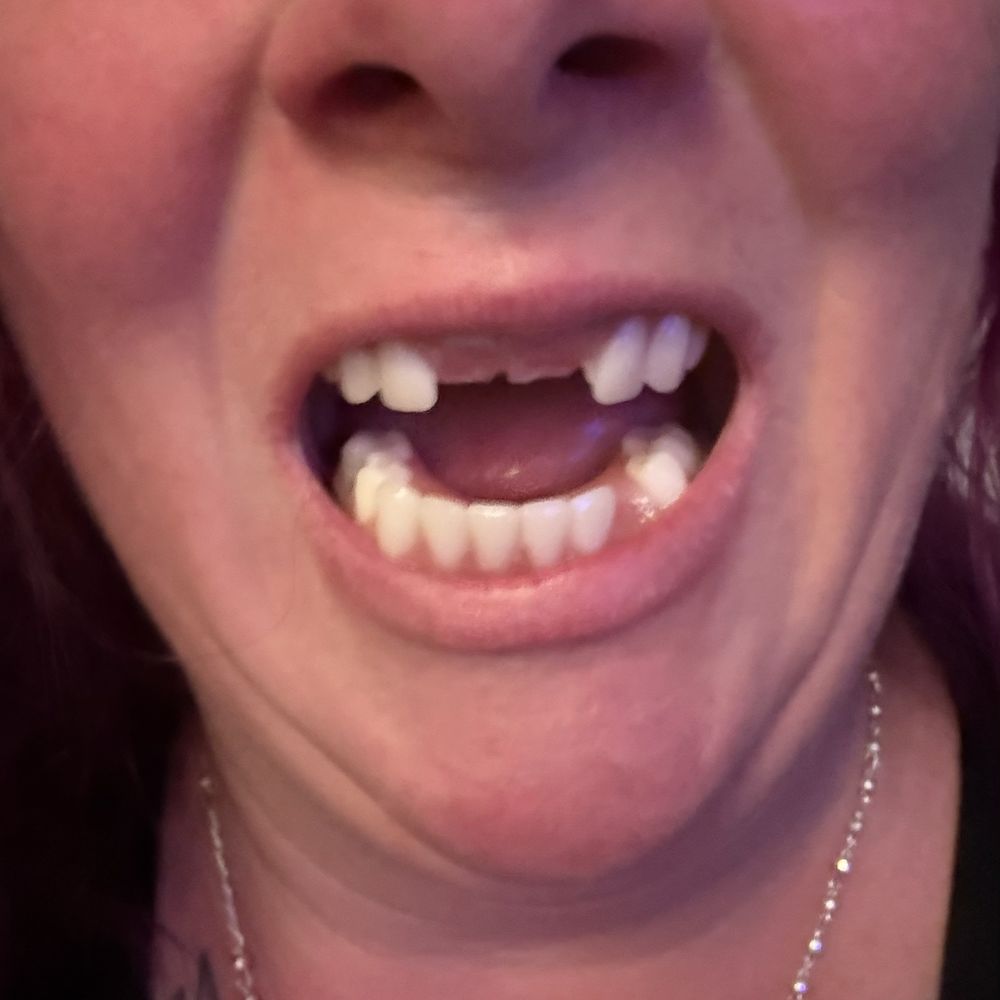 Affordable Dentures & Implants - Here is an update to what $32,870 dollars gave me which after i finish paying my loan i took out i will have paid $52,870 to look like this. - Cosmetic Dentists Near Me - Windsor, California