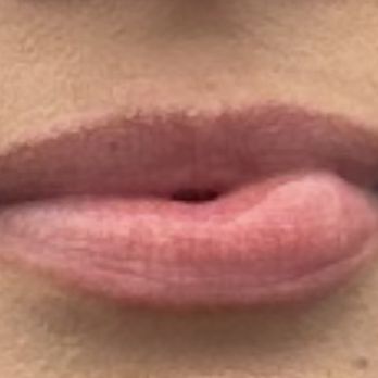 Smile Straight Orthodontics - Molecular Cyst caused by the tech during braces removal. - Orthodontists Near Me - Phoenix, Arizona Smile Straight Orthodontics - Molecular Cyst caused by the tech during braces removal. - Orthodontists Near Me - Phoenix, Arizona