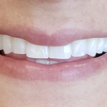 Struble Orthodontics - Look at the beautiful smile Dr. Struble gave me! - Orthodontists Near Me - Bend, Oregon